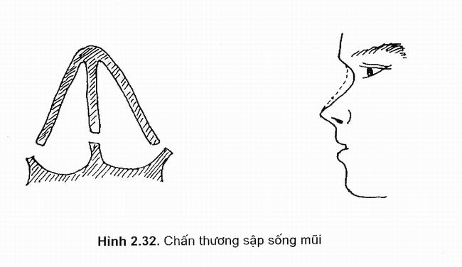 Chấn thương mũi - Hình ảnh minh họa